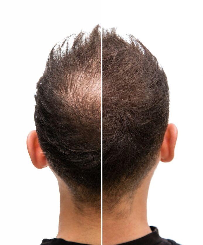 Back of a man’s head, half with bald patch and half without.