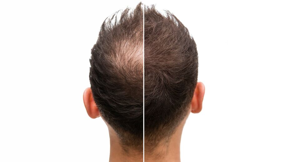 Back of a man’s head, half with bald patch and half without.